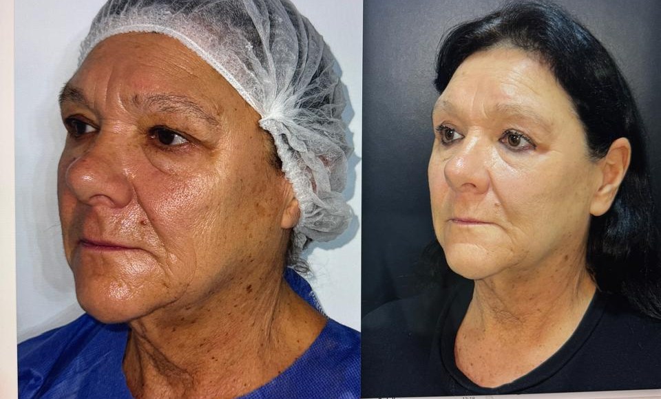 Antes y después, caso 1, de perfil
