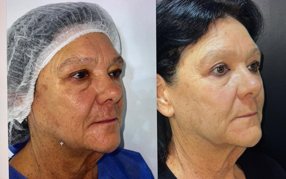 Antes y después, caso 1, tres cuartos de perfil