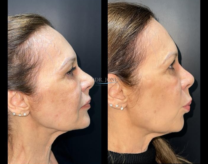 Antes y después, caso 2, de perfil